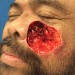 Mohs Face Patient 01 Thumbnail After