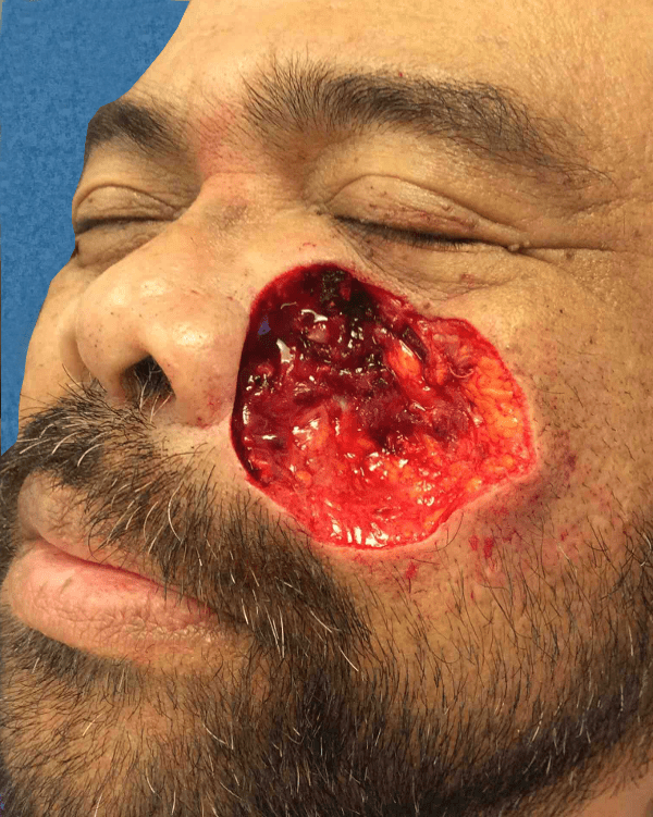 Mohs Face Patient 01 After