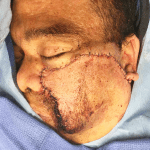 Mohs Face Patient 01 Thumbnail Before - 2