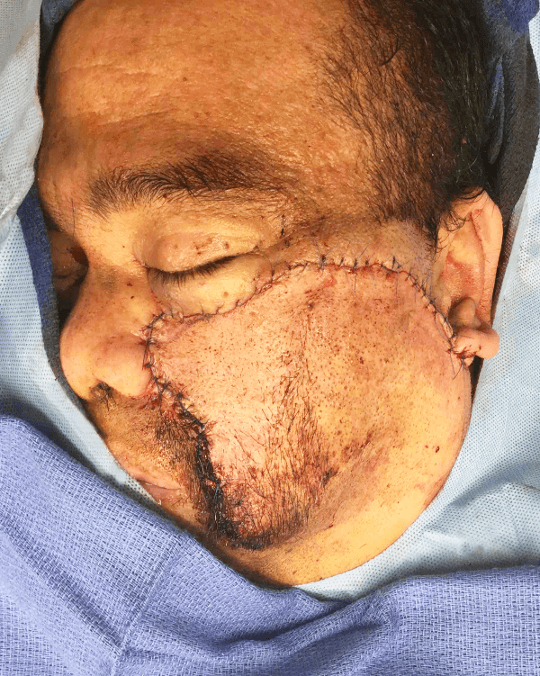 Mohs Face Patient 01 Before - 2