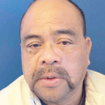 Mohs Face Patient 01 Thumbnail After - 2