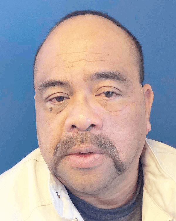 Mohs Face Patient 01 After - 2