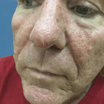 Mohs Nose Patient 09 Thumbnail Before