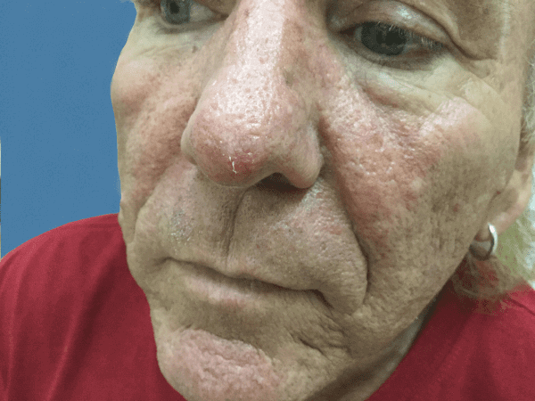 Mohs Nose Patient 09 Before