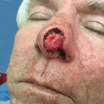 Mohs Nose Patient 09 Thumbnail After