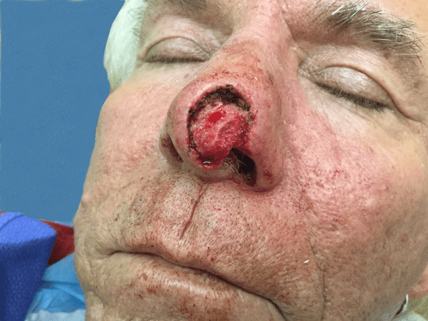 Mohs Nose Patient 09 After