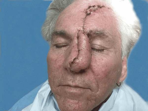 Mohs Nose Patient 09 Before - 2