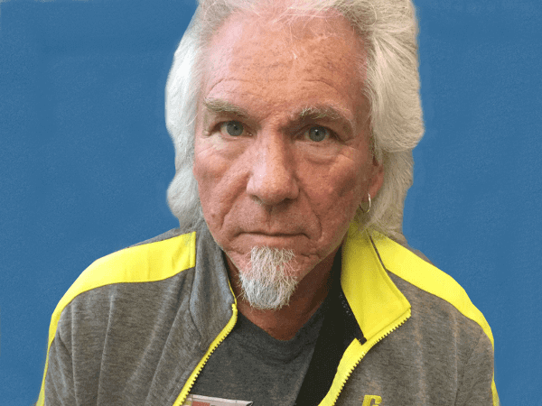 Mohs Nose Patient 09 After - 2