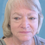 Mohs Nose Patient 06 Thumbnail After - 2