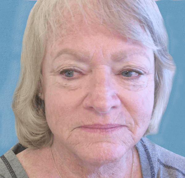 Mohs Nose Patient 06 After - 2