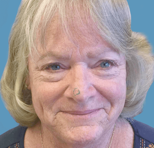 Mohs Nose Patient 06 Before