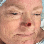 Mohs Nose Patient 06 Thumbnail After