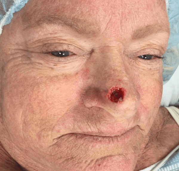 Mohs Nose Patient 06 After