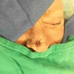 Mohs Nose Patient 06 Thumbnail Before - 2
