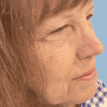 Mohs Nose Patient 05 Thumbnail Before