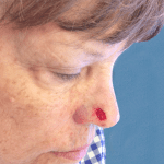 Mohs Nose Patient 05 Thumbnail After