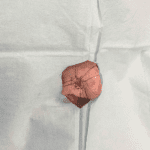 Mohs Nose Patient 05 Thumbnail Before - 2