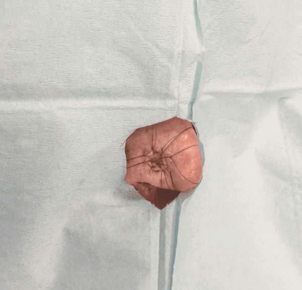 Mohs Nose Patient 05 Before - 2