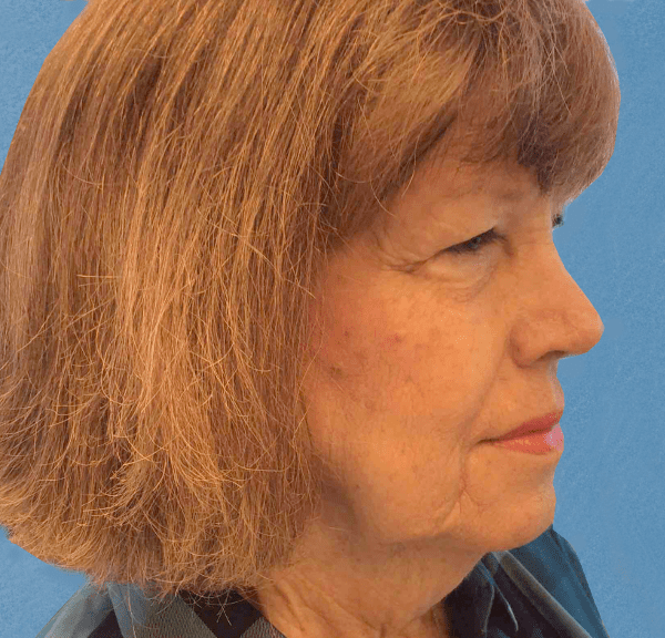 Mohs Nose Patient 05 After - 2