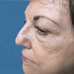 Mohs Nose Patient 07 Thumbnail After - 2