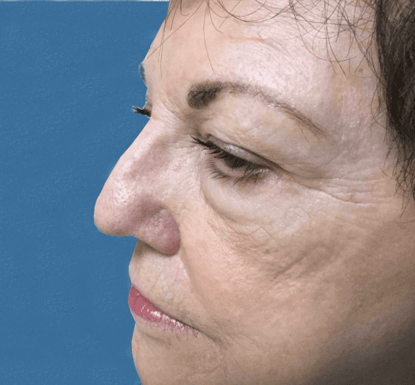 Mohs Nose Patient 07 After - 2