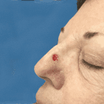 Mohs Nose Patient 07 Thumbnail After