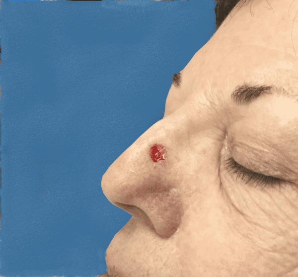 Mohs Nose Patient 07 After