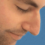 Mohs Nose Patient 08 Thumbnail Before