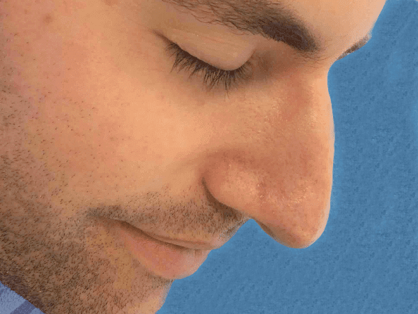 Mohs Nose Patient 08 Before