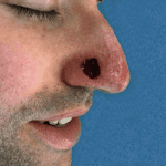 Mohs Nose Patient 08 Thumbnail After