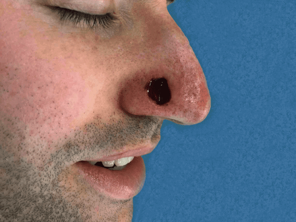 Mohs Nose Patient 08 After