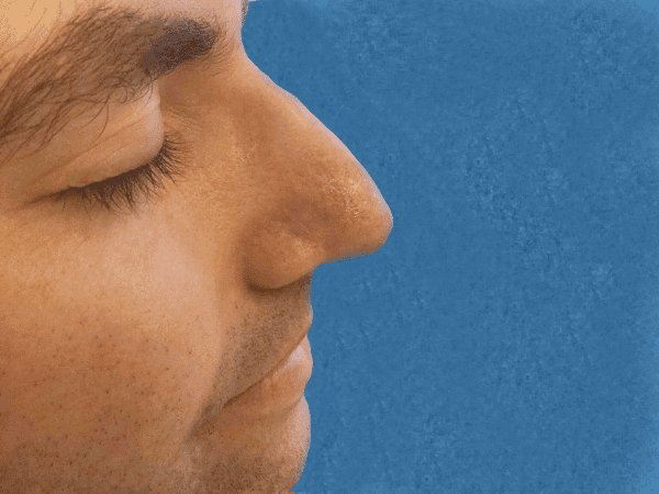 Mohs Nose Patient 08 After - 2