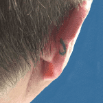 Mohs Ear Patient 02 Thumbnail Before