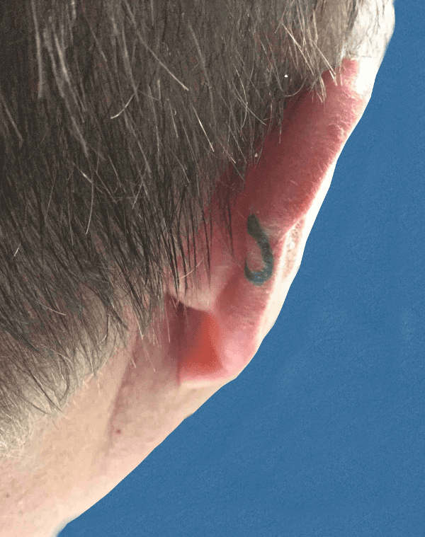 Mohs Ear Patient 02 Before