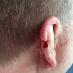 Mohs Ear Patient 02 Thumbnail After