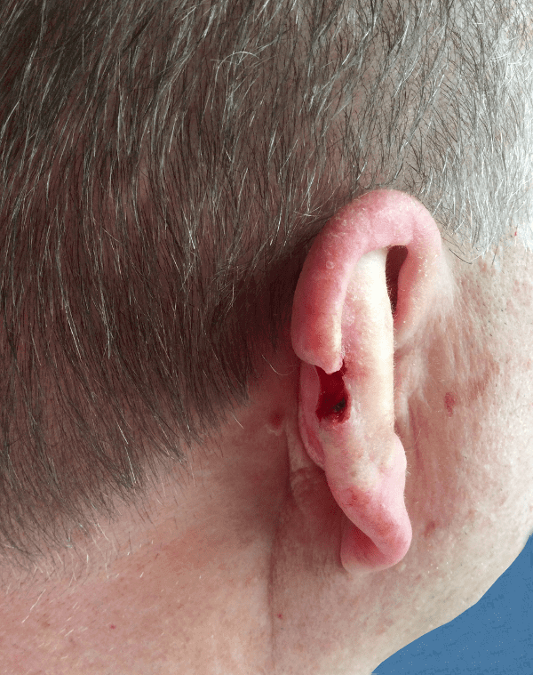 Mohs Ear Patient 02 After