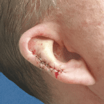 Mohs Ear Patient 02 Thumbnail Before - 2