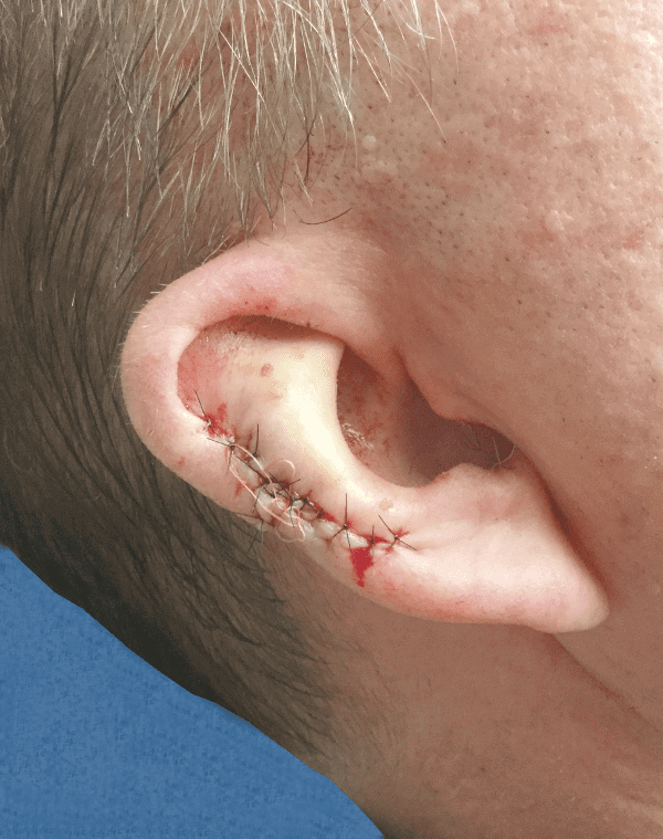 Mohs Ear Patient 02 Before - 2