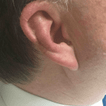 Mohs Ear Patient 02 Thumbnail After - 2