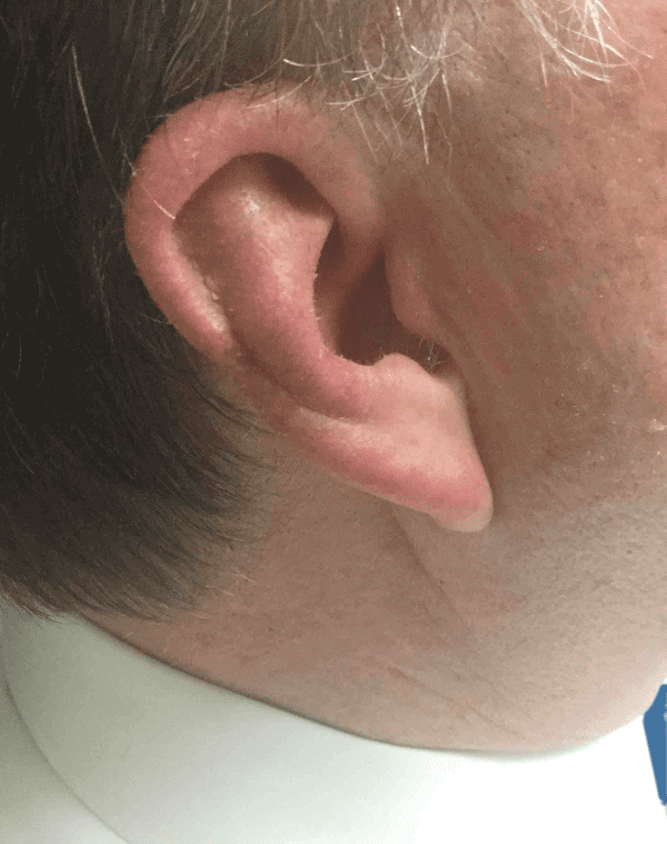 Mohs Ear Patient 02 After - 2