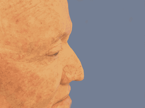 Blepharoplasty Patient 02 After - 2