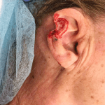 Mohs Ear Patient 03 Thumbnail After