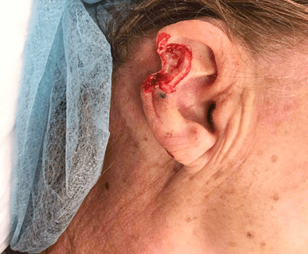 Mohs Ear Patient 03 After