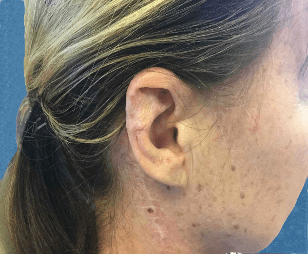 Mohs Ear Patient 03 After - 2
