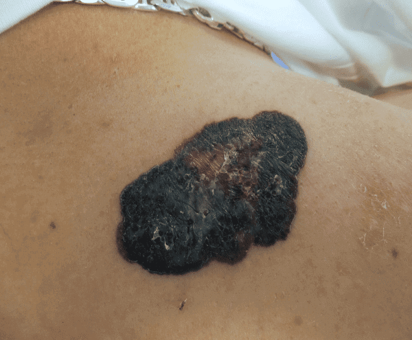 Excision Patient 01 Before