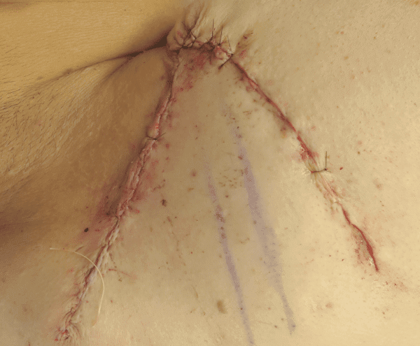 Excision Patient 01 After