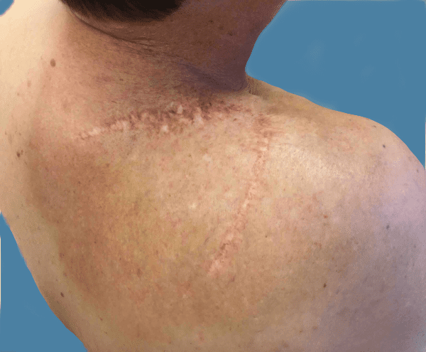 Excision Patient 01 Before - 2