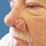 Excision Nose Patient 01 Thumbnail After