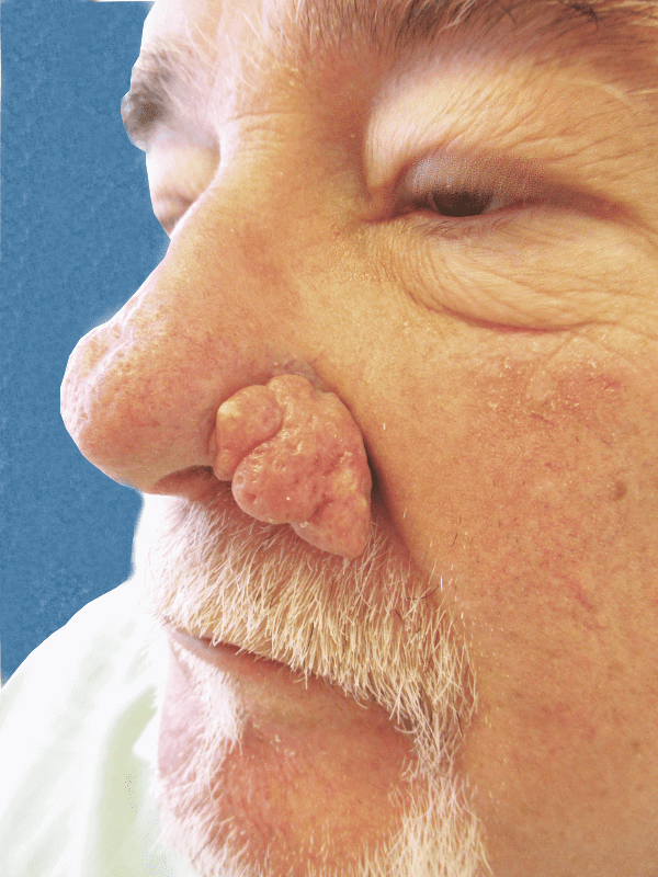 Excision Nose Patient 01 After