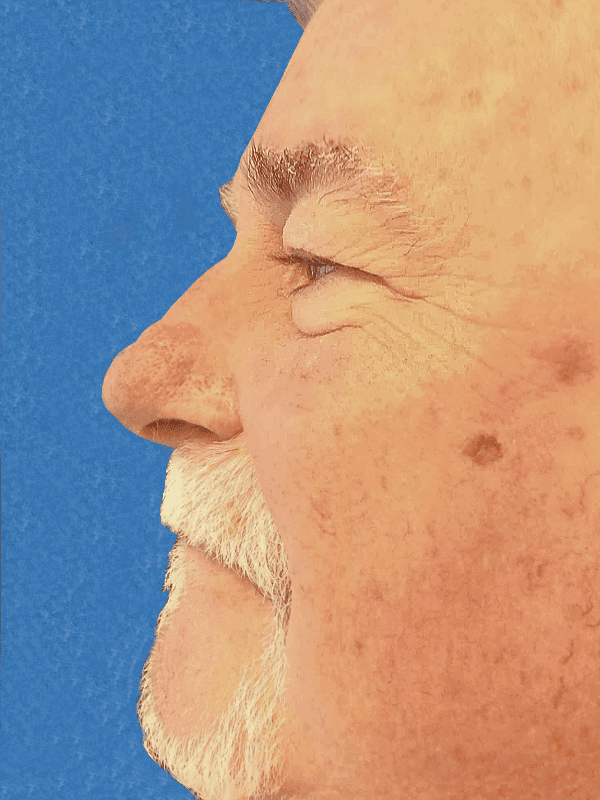 Excision Nose Patient 01 After - 2